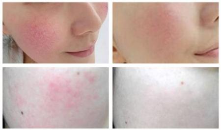  红血丝怎么去掉？最有效的去除方法赶紧试试吧 互联百科 第3张