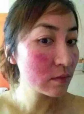  红血丝怎么去掉？最有效的去除方法赶紧试试吧 互联百科 第2张