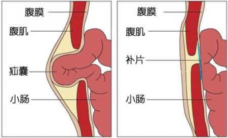 什么是疝气病？疝气是什么原因引起的 互联百科